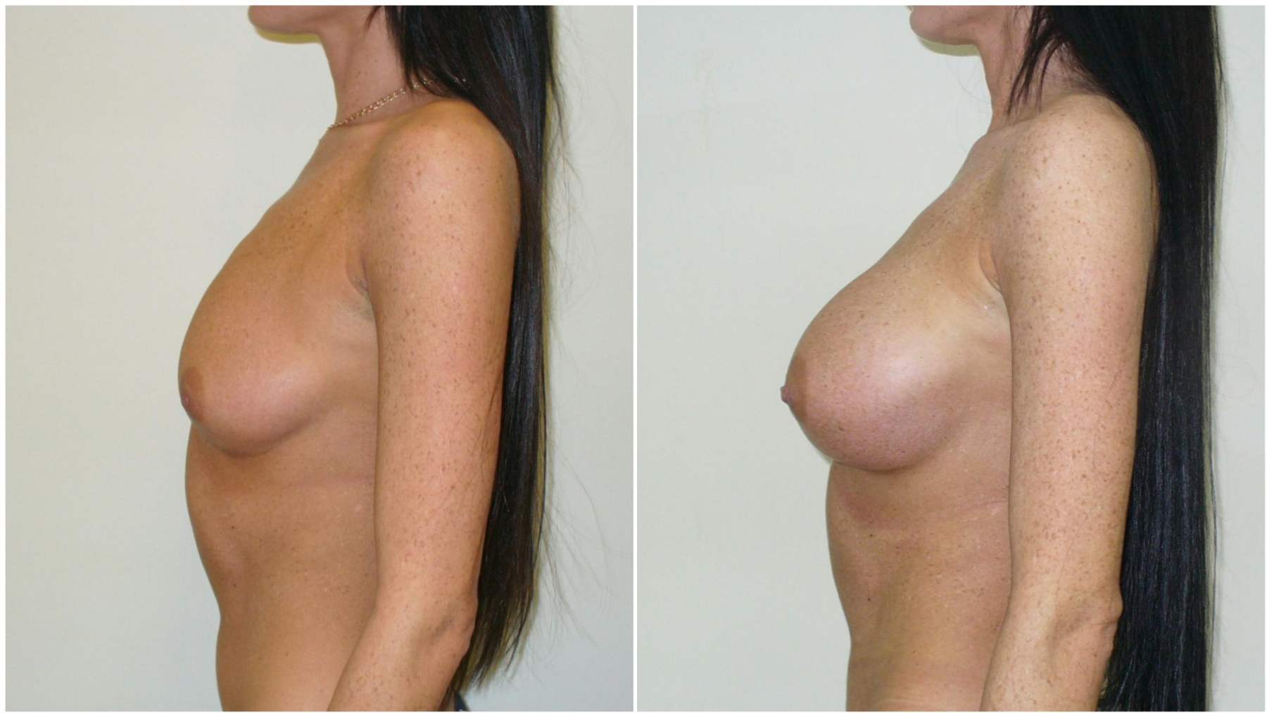 170 cm, 55 kg, anatominiai 335 ml implantai su vidiniu pakėlimu