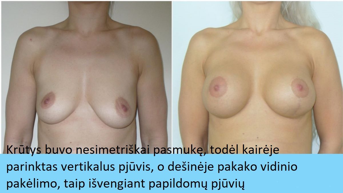 Nesimetriškos krūtys kleltos su 390 ml anatominiais implantais