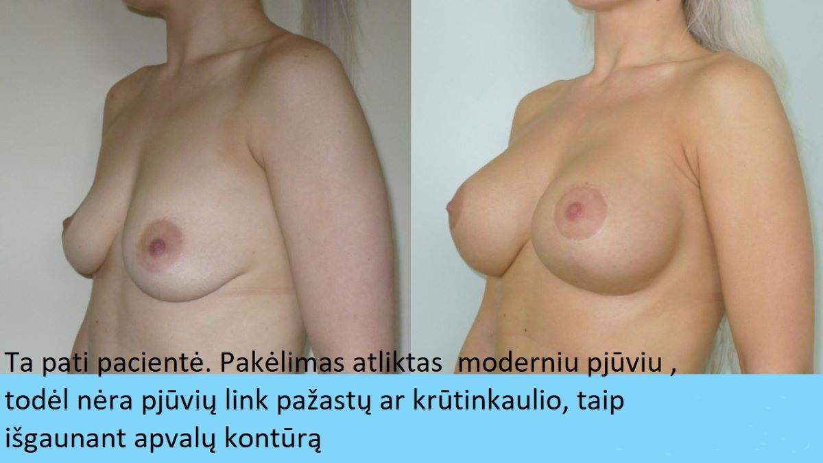 Prieš ir po 2 m. 4 mėn. Vertikalus randas žemiau areolės siauras, šone randų nėra